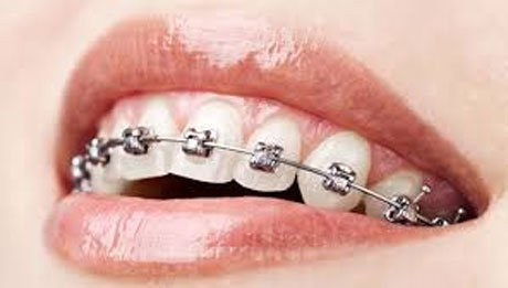 Orthodontic Treatment in Vaishali Nagar Jaipur