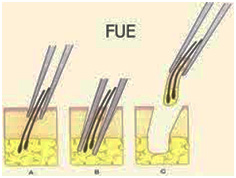 hair transplant jaipur