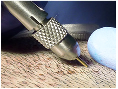 hair transplant in vaishali nagar