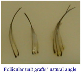 hair transplantation jaipur