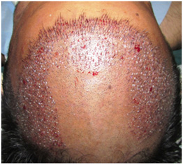 hair transplant treatment jaipur
