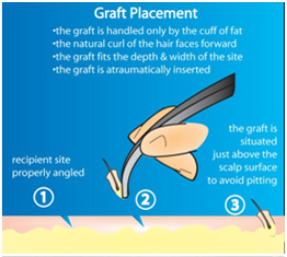 hair transplant treatment in vaishali nagar