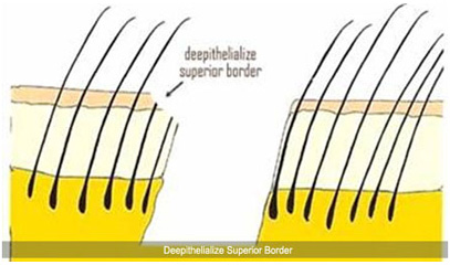 hhair transplant in vaishali nagar jaipur