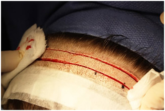 hair transplantation in vaishali nagar jaipur