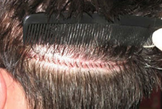 hair transplant treatment in vaishali nagar jaipur