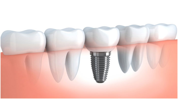 Implant Dentistry in Jaipur