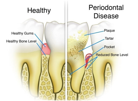 Best Periodontics Treatment in Jaipur