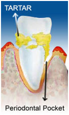 Best Periodontics Treatment in Vaishali Nagar Jaipur