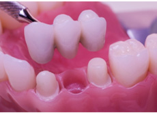 Best Prosthodontics Treatment in Vaishali Nagar Jaipur