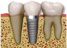Prosthodontics Treatment in Vaishali Nagar