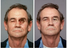 Best Prosthodontics Treatment Jaipur